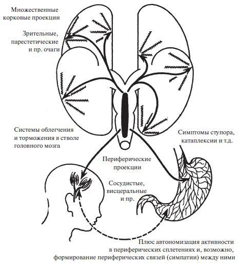 Мигрень