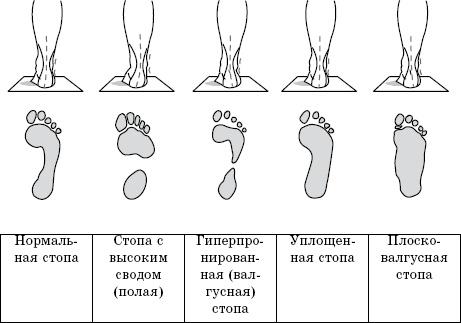 Плоскостопие. Самые эффективные методы лечения