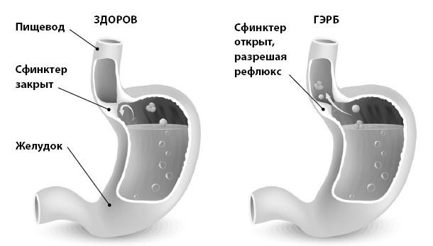 Кишечник с комфортом, желудок без проблем